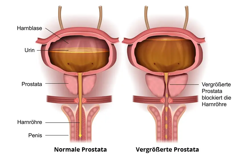 Inkontinenz nach Prostata OP Schaubild