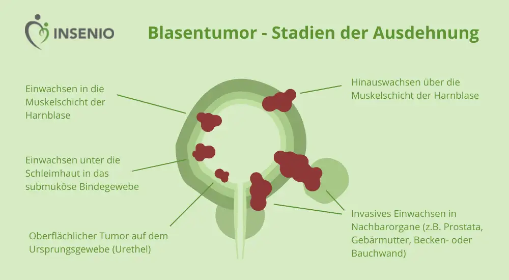 Infografik Blasentumor