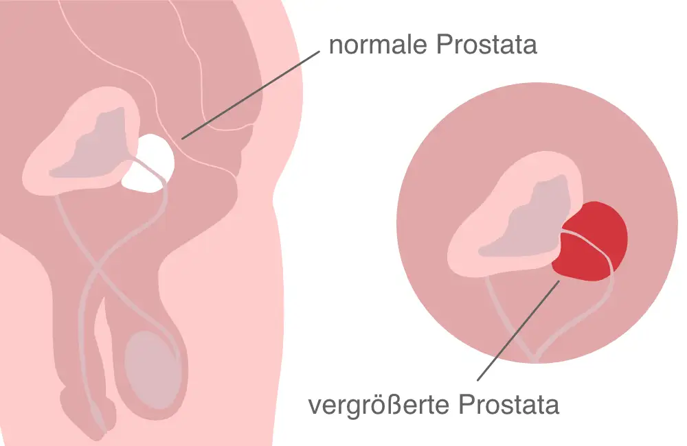 Schaubild vergrößerte Prostata