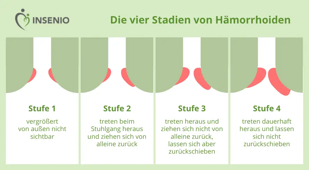 Infografik Hämerrhoiden