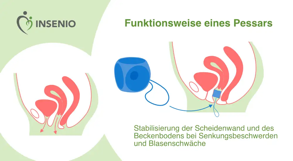 Infografik Funktionsweise Pessar